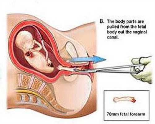 孕期知识：刚代孕要学会保护自己和胎儿